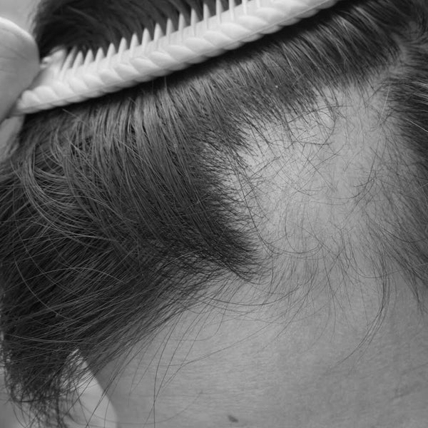 How COVID-19 Causes Hair Loss